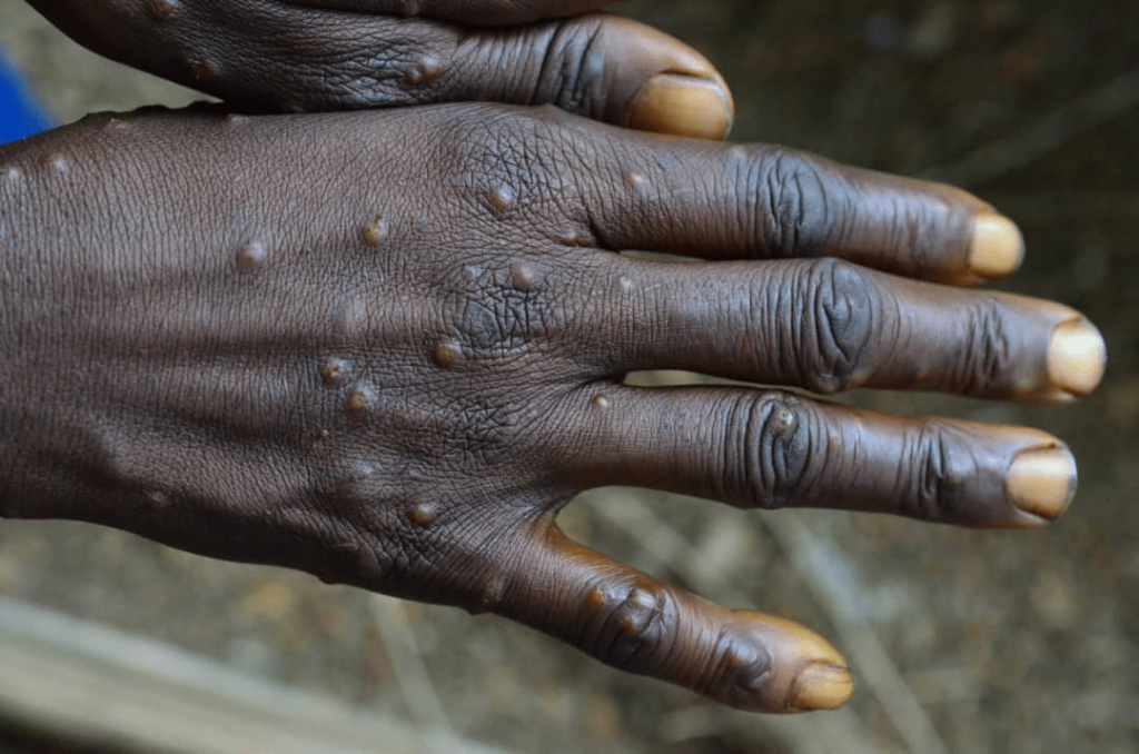 Alerte Sanitaire à Ouandja : Une Maladie Inconnue Provoque des Décès d'Enfants
